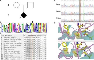 Prenatal Diagnosis in a Fetus With X-Linked Recessive Chondrodysplasia Punctata: Identification and Functional Study of a Novel Missense Mutation in ARSE